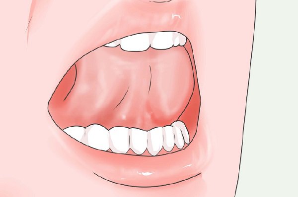Nguyên nhân của tật đẩy lưỡi